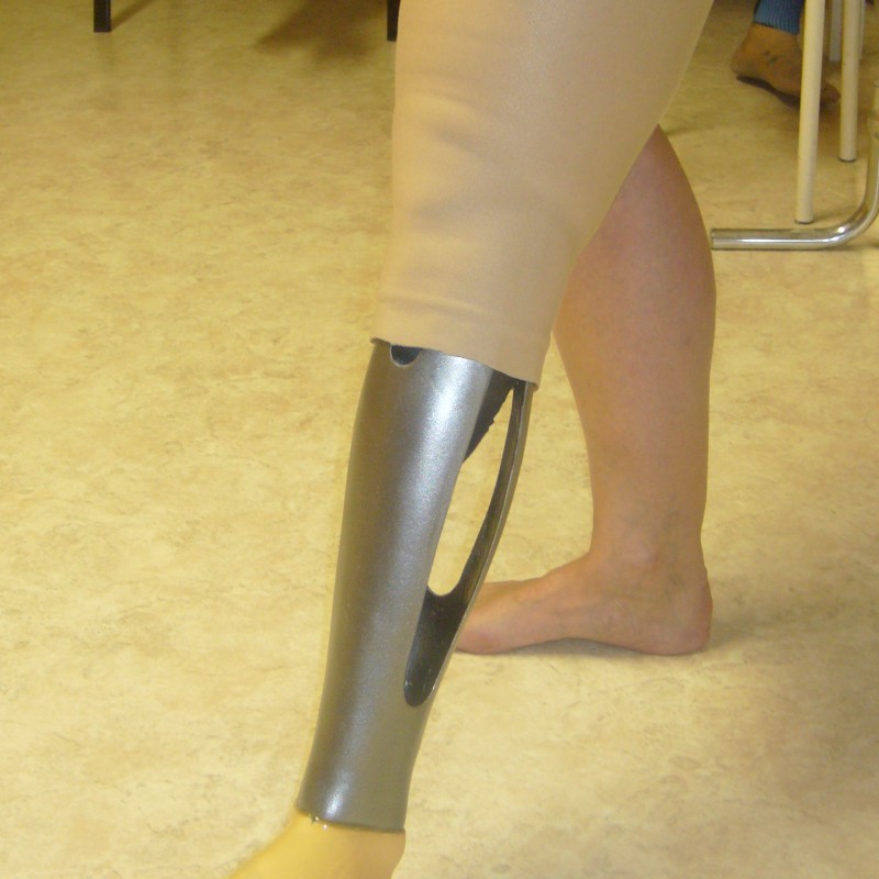 Kurzstumpfprothese mit tragendem Aussenrahmen Vakuumbettung