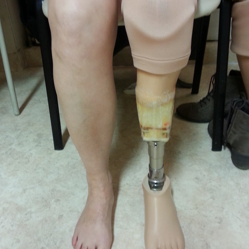 Unterschenkelprothese probefertig Stellungsanpassung